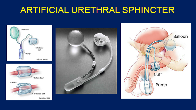 Artificial urinary sphincter