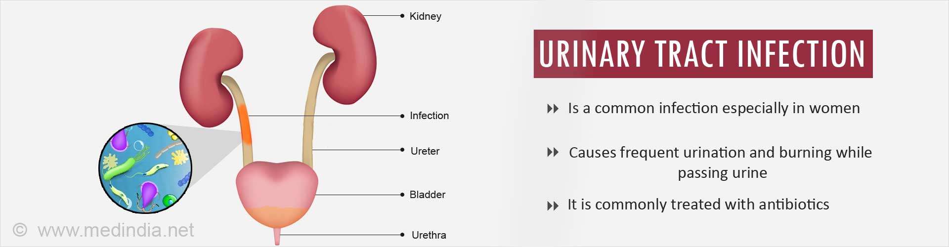 How to Prevent Urinary Tract Infection Recurrence Without Antibiotics