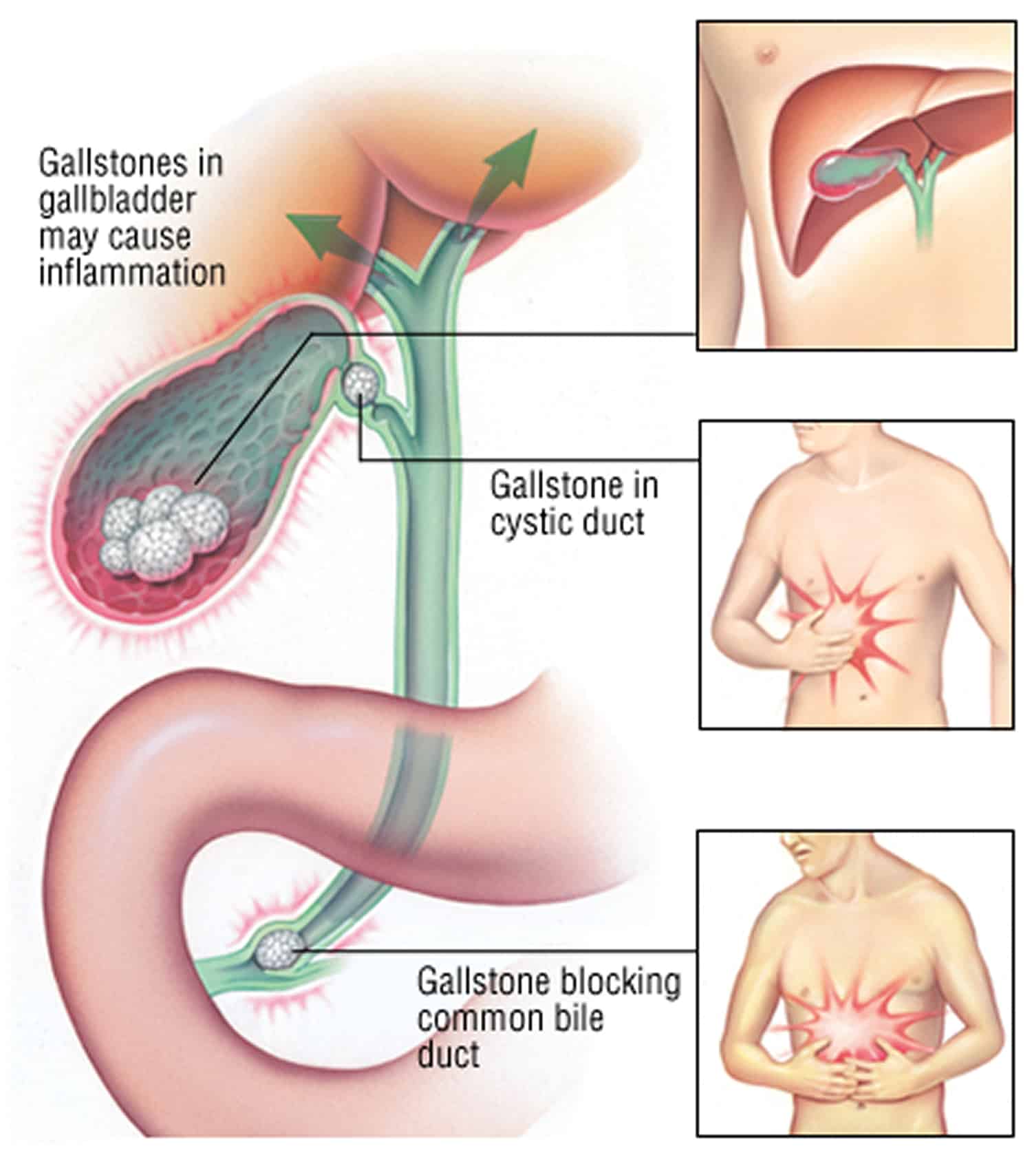 Hydrocodone gall bladder pain *** Dec 21, · Gallbladder removal ...