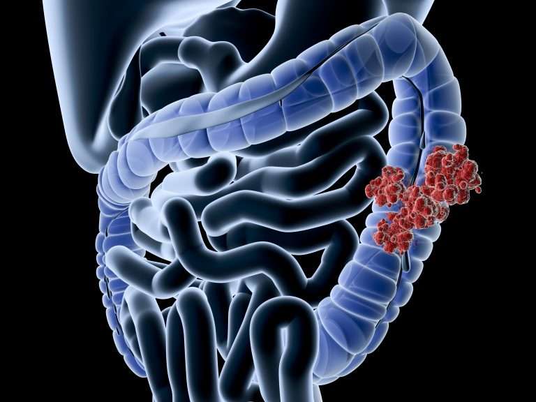 Intestinal E. Coli Infections