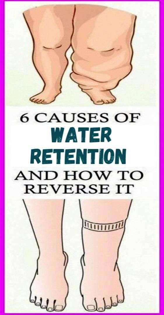 Kidneys Water Retention Legs