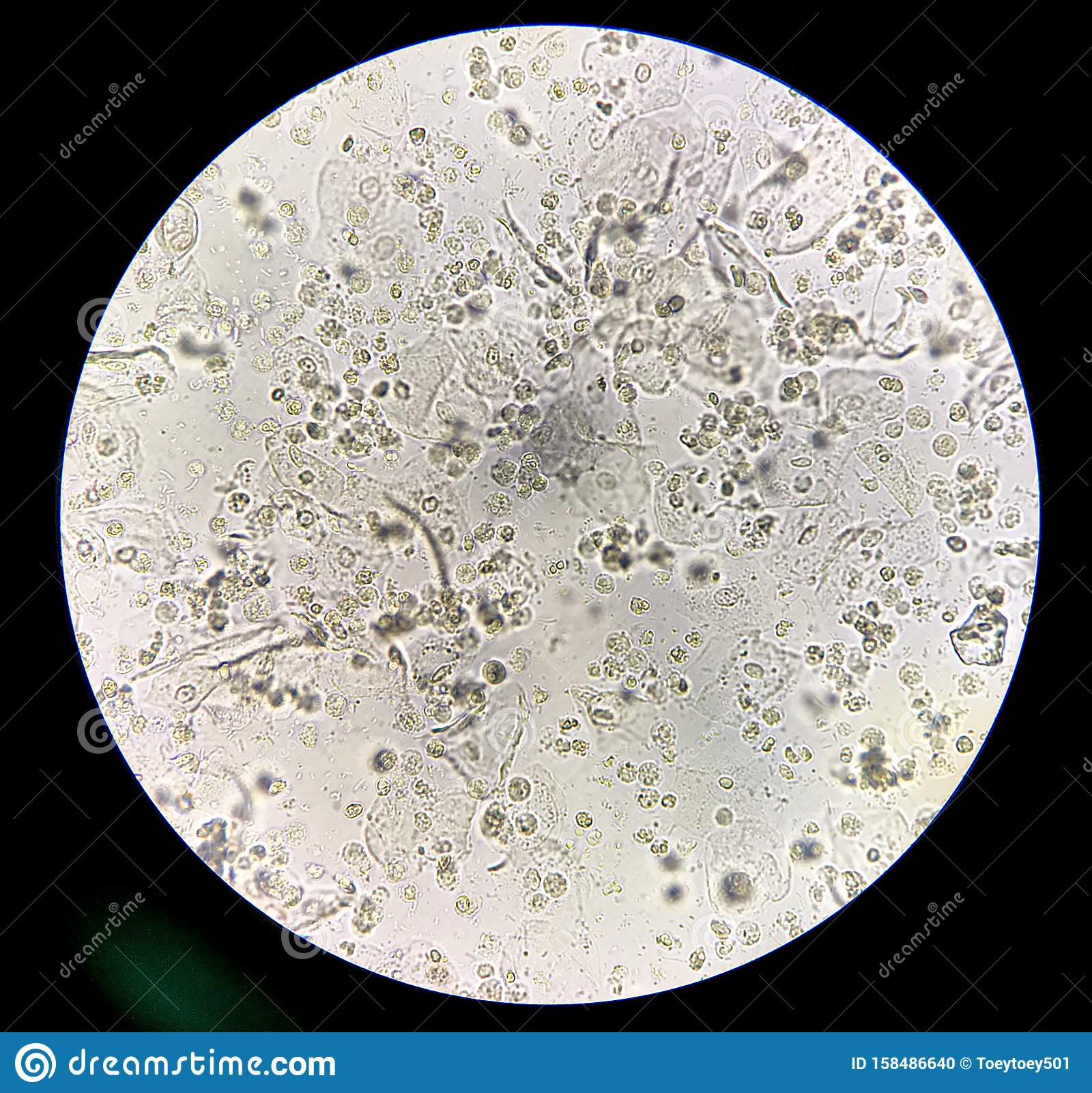 Moderate Bacteria And White Blood Cells In Patien Bacteria Urinary ...