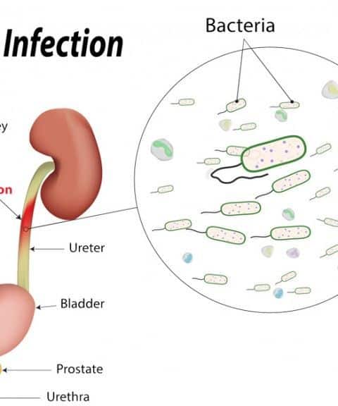 Natural And Effective Home Remedies For Urinary Tract Infection ...
