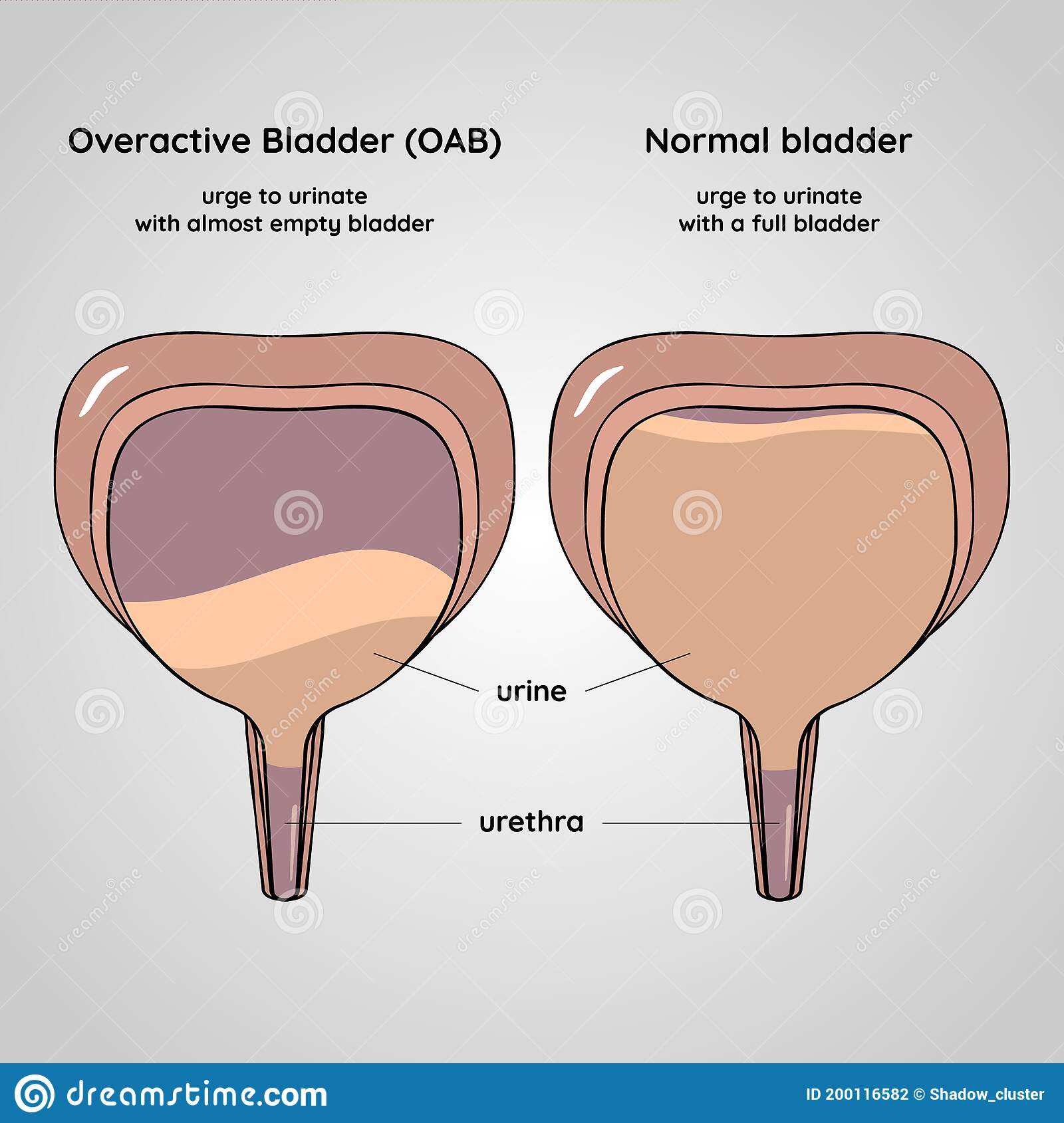 Overactive and Normal Bladder. Urinary System Disease Stock Vector ...