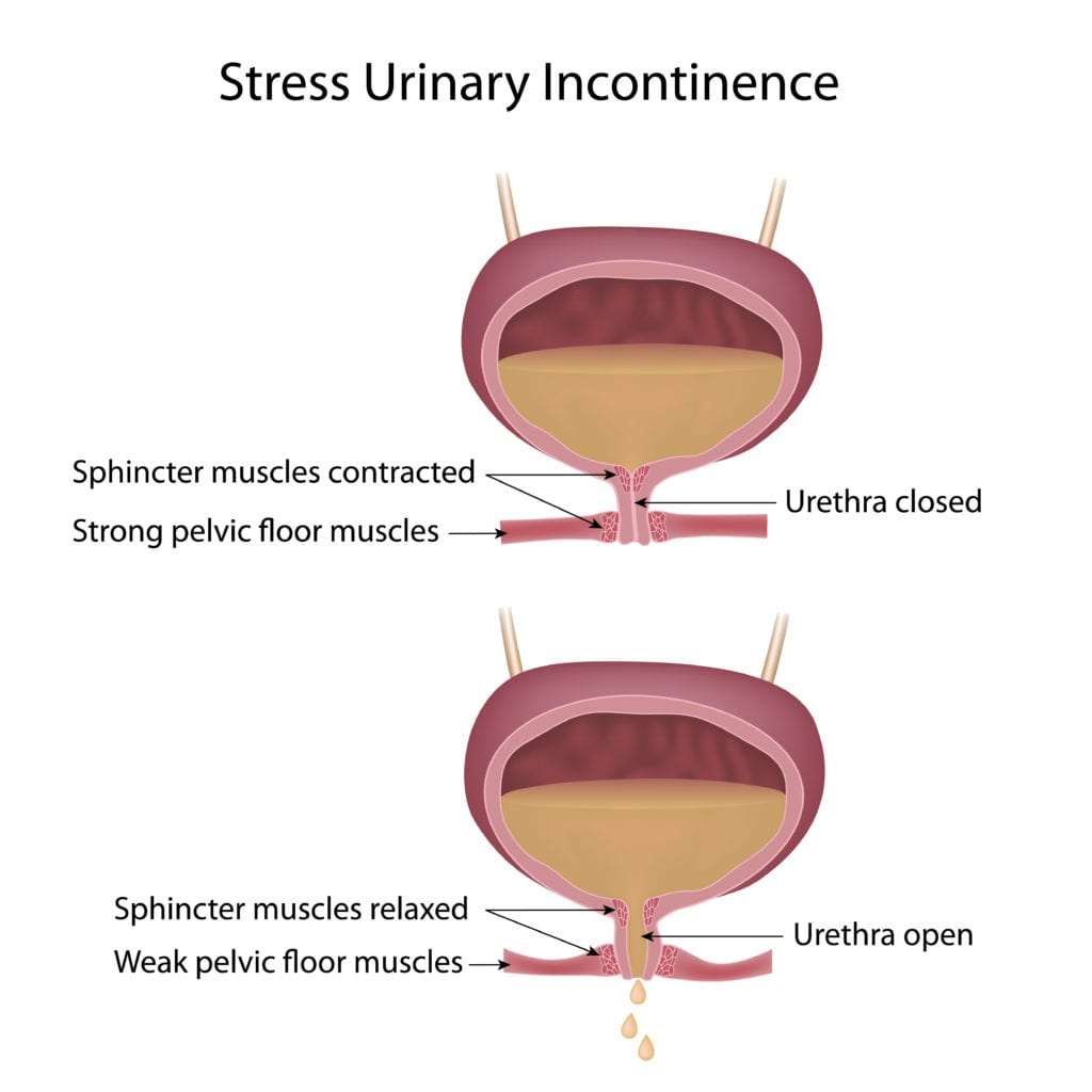 Stress Urinary Incontinence and Diastasis Recti