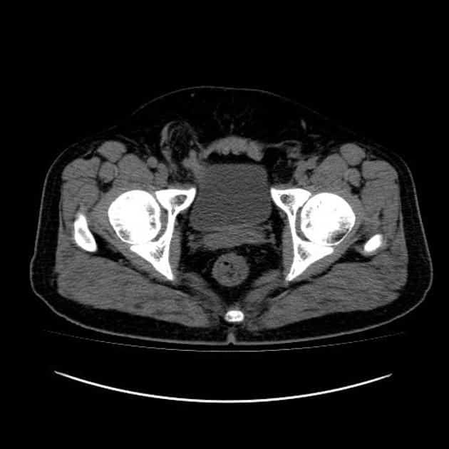 Urinary bladder in inguinal hernia