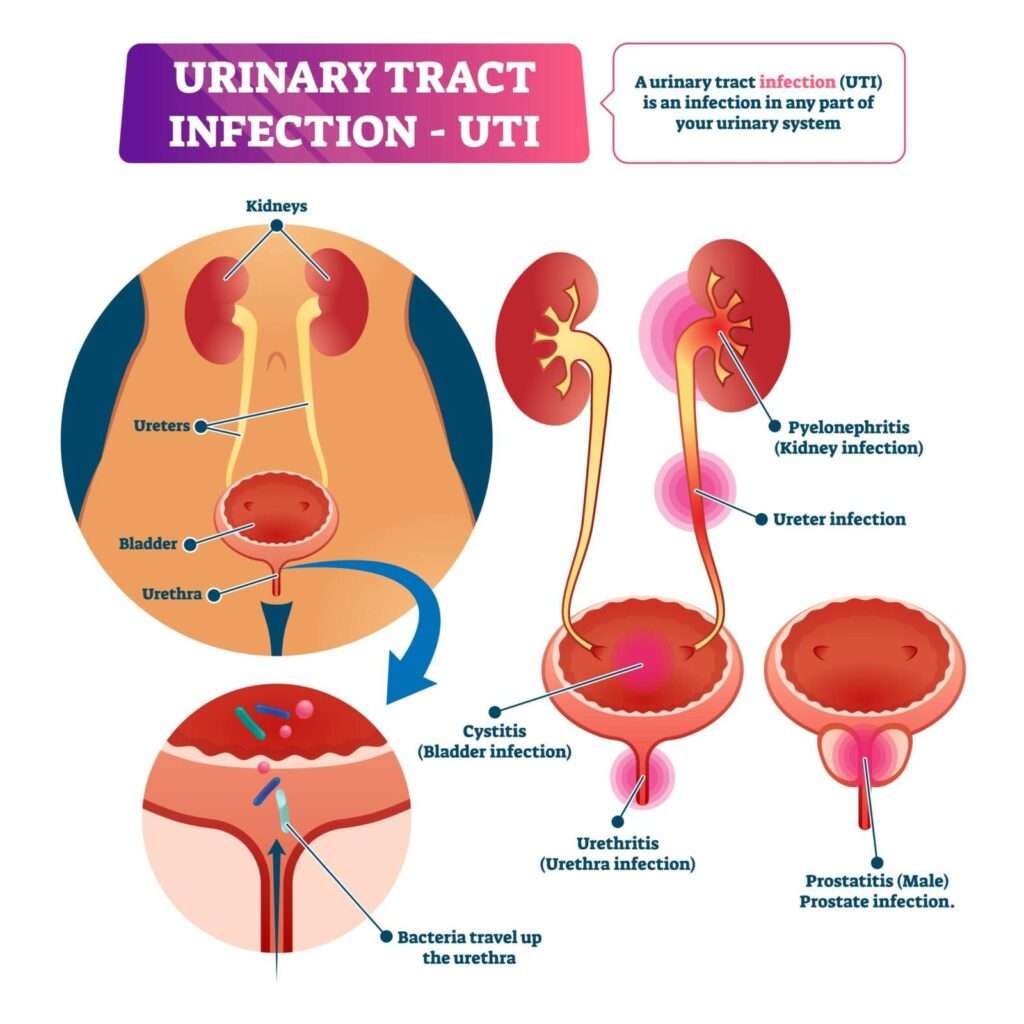 Urinary Tract Infection And Alcohol