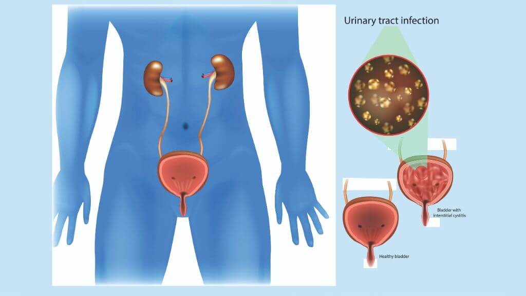 urinary trac infection