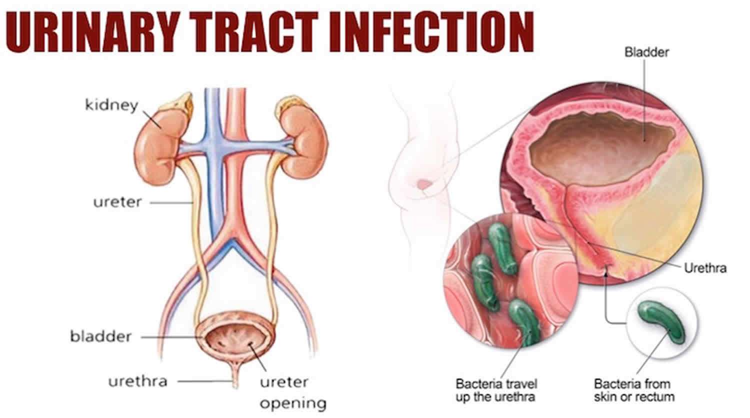 Urinary tract infection causes, symptoms, diagnosis ...
