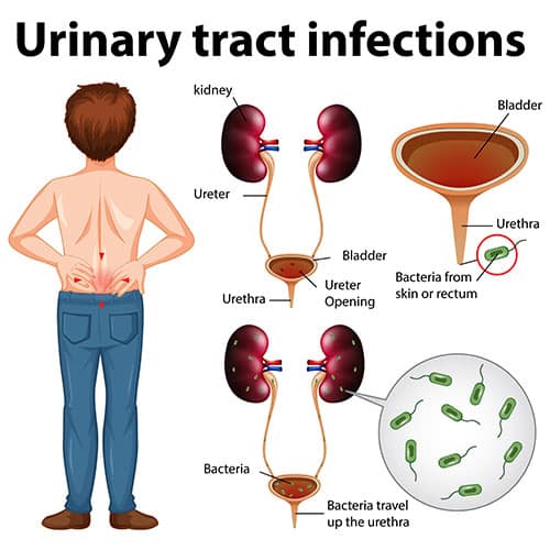 Urinary Tract Infection in men â symptoms, causes and treatment ...