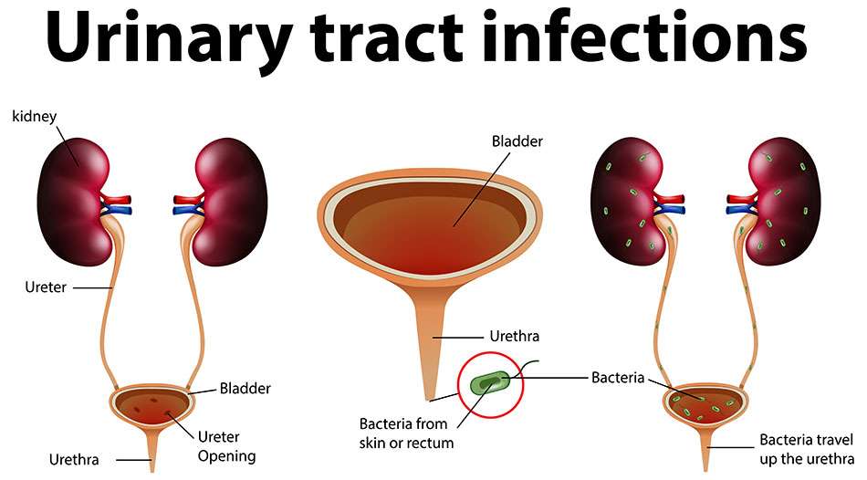 Urinary Tract Infection UTI Specialist Doctor in Pune